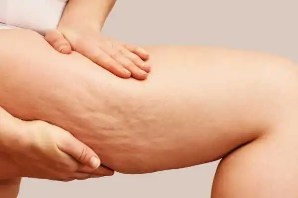 Image of woman showing leg with cellulite Clacton