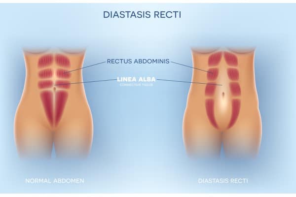 How Does Non-Surgical Treatment Help With Loose Skin, Weak Abdominal Muscles and Post-Pregnancy Changes Clacton?