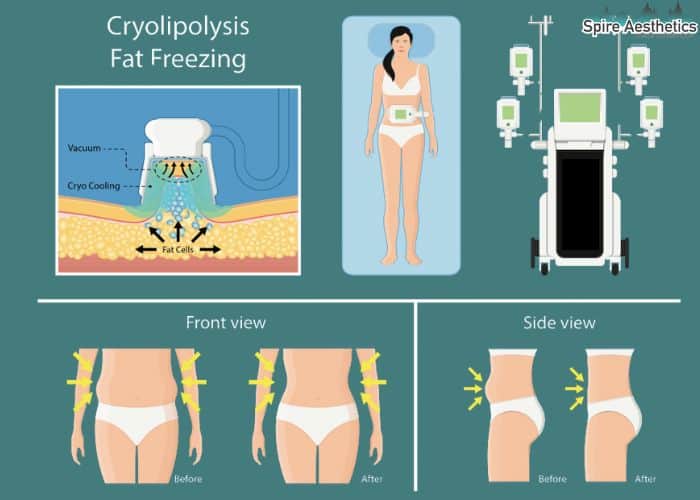 Image of diet and fat freezing combined for best results for Spire Aesthetics Clacton
