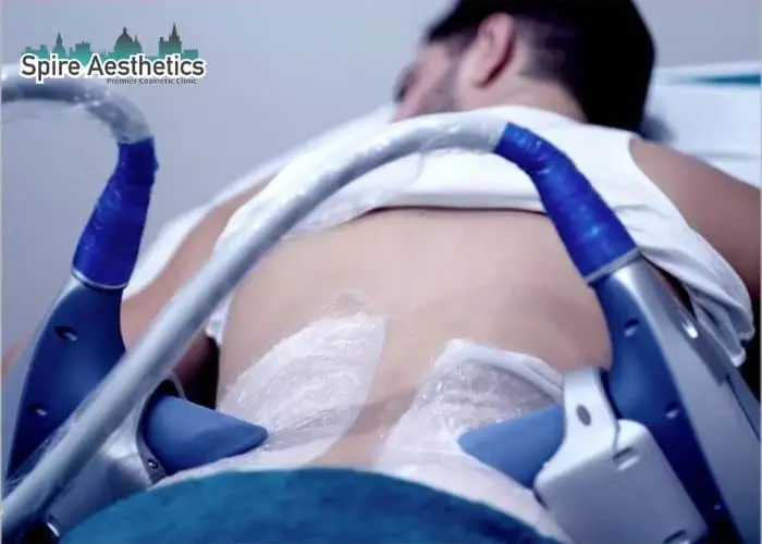 Man having fat freezing treatment done on love handles before a competitions Clacton to create a sculpted look.