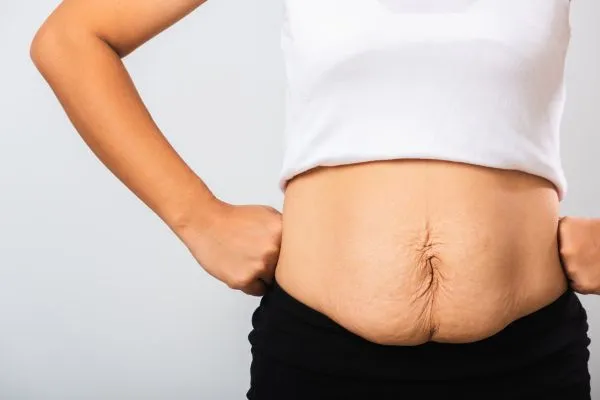 Image of a woman's stomach after weight loss with sagging skin following a gastric band Clacton