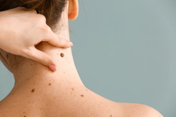 skin blemish removal Clacton treatment