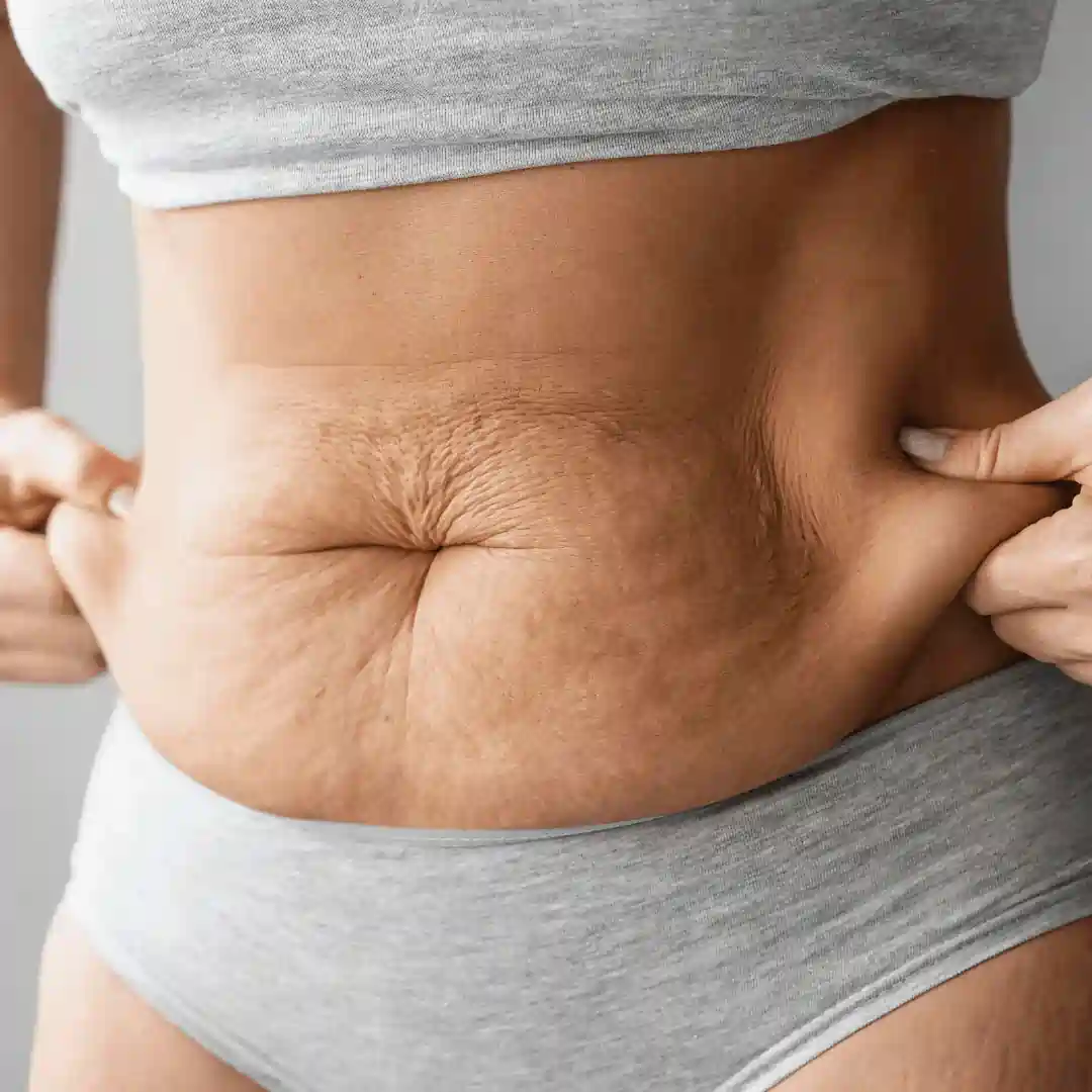 Is It Normal to Have Loose Skin After Pregnancy Clacton?