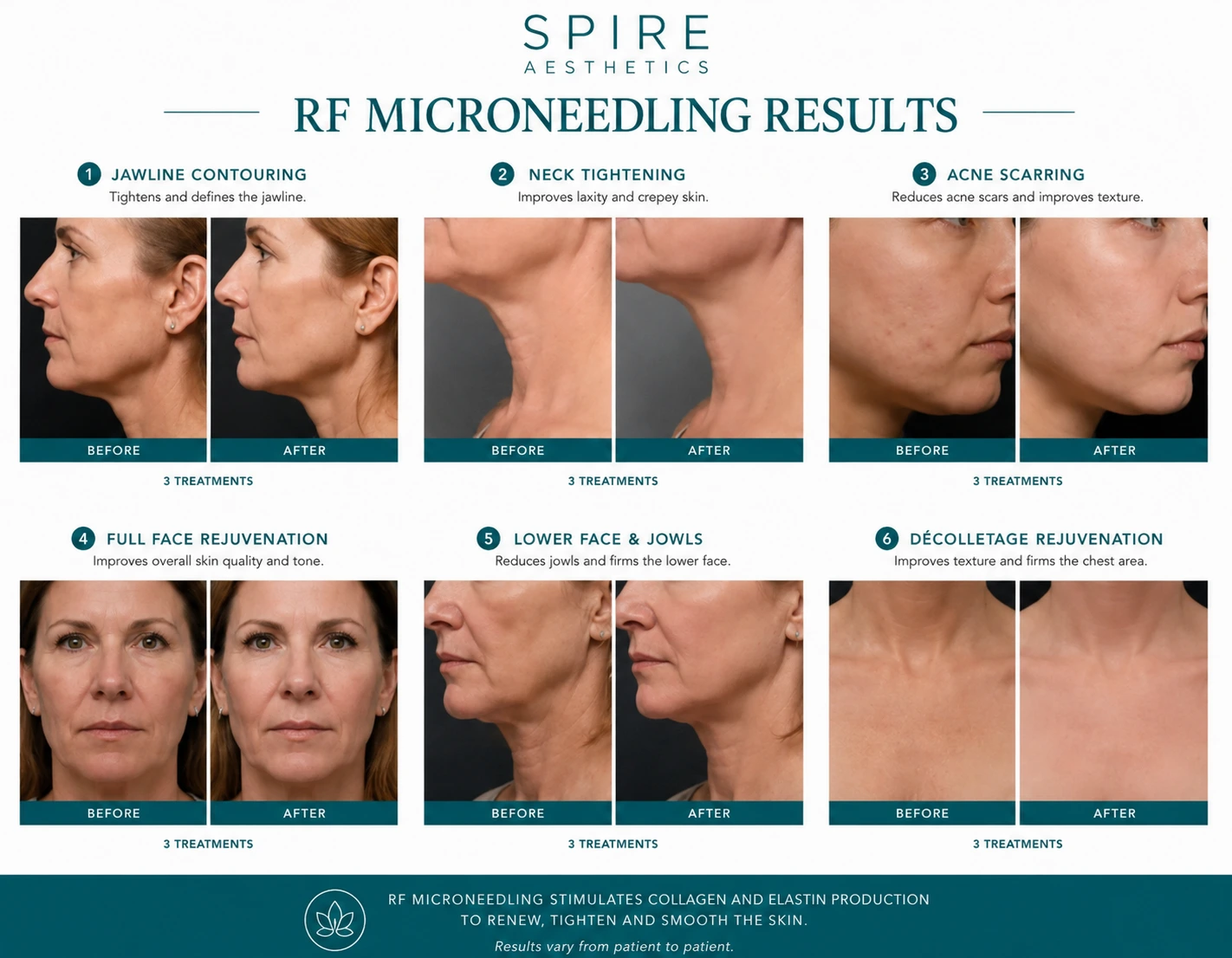 RF Microneedling Skin tightening Clacton results