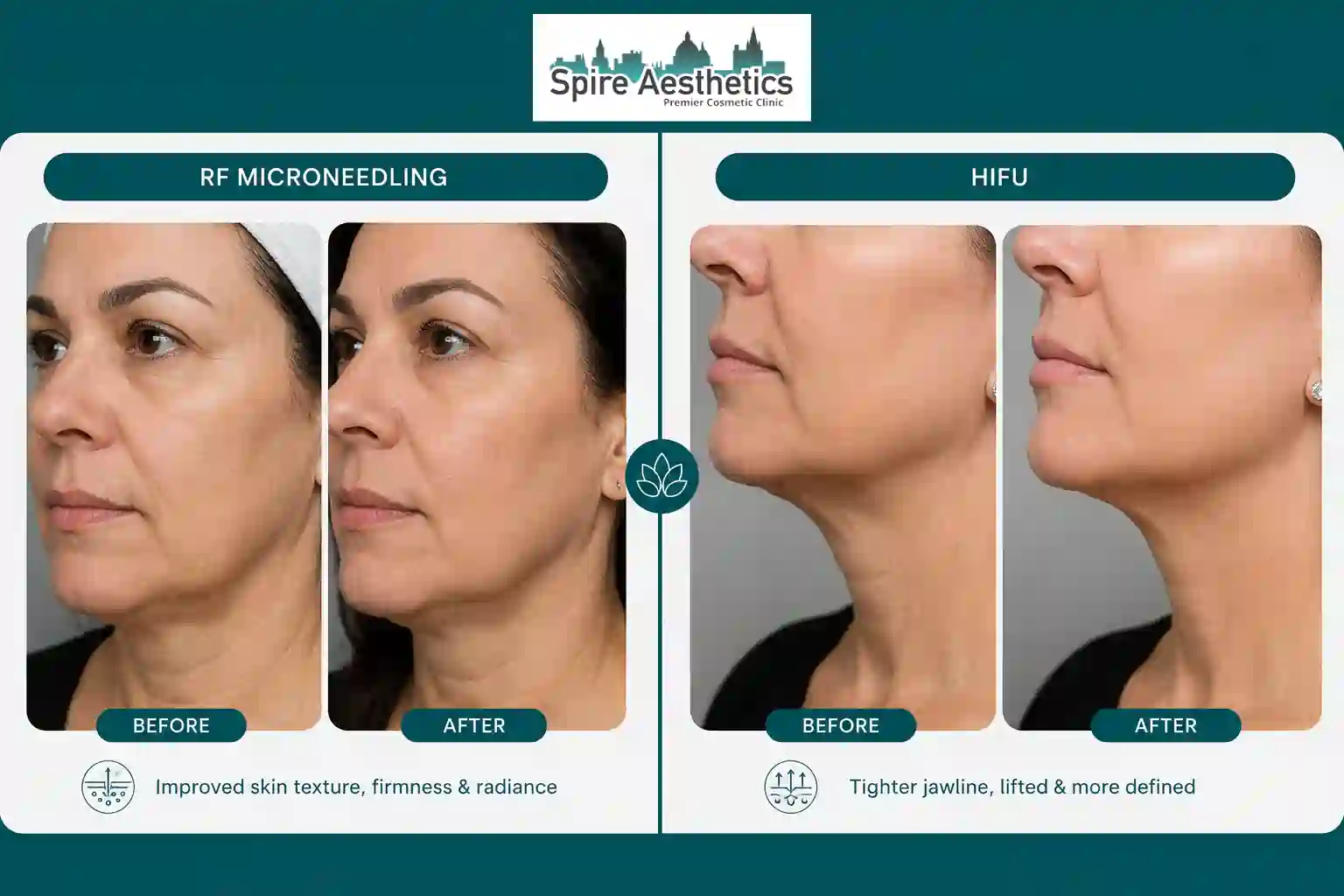 Can RF Microneedling and HIFU Be Combined Clacton?