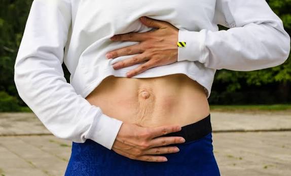 When Could Diastasis Recti Be the Missing Piece of the Puzzle Clacton?