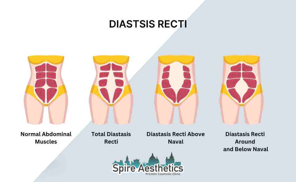Is Non-Surgical Diastasis Recti Treatment Right for You? Common Concerns Answered Clacton